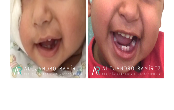 Reconstruccion-nervio-dr-ramirez.png