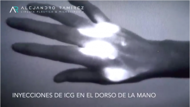 En pie de guerra contra el linfedema