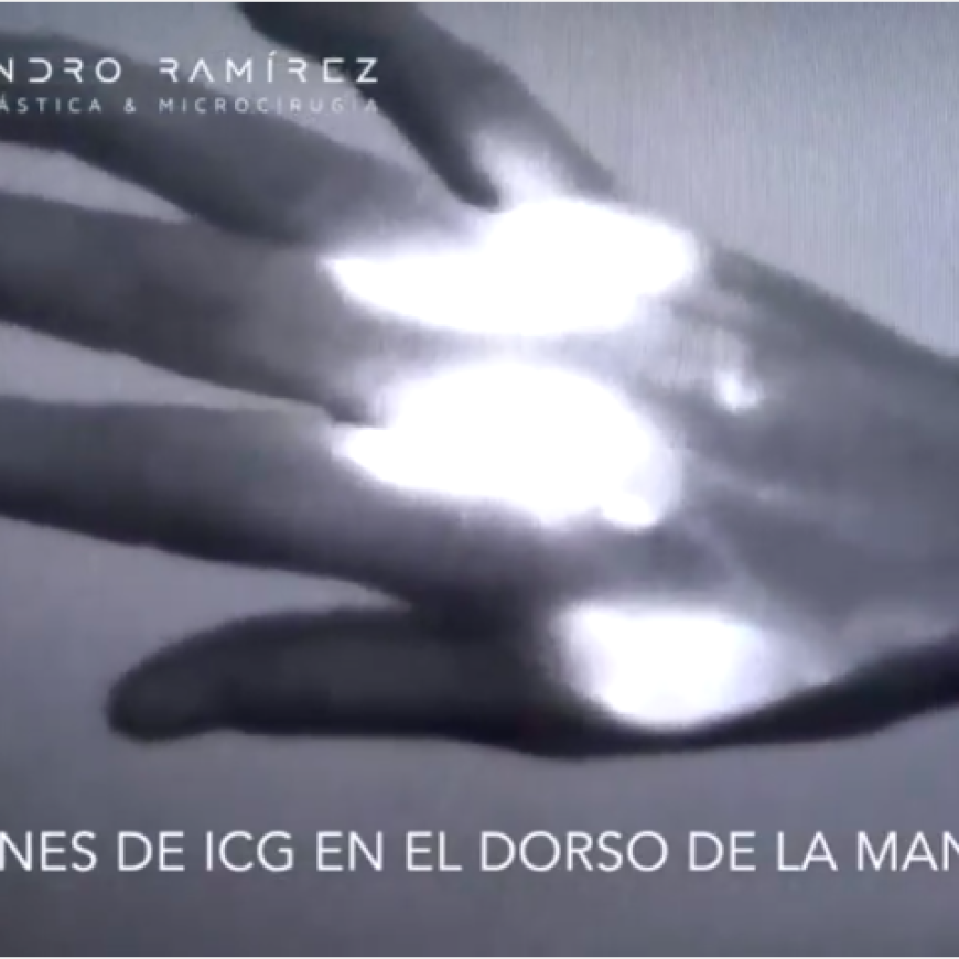 En pie de guerra contra el linfedema