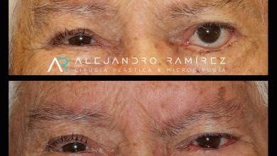 Reconstrucción facial: Microcirugía en parálisis facial