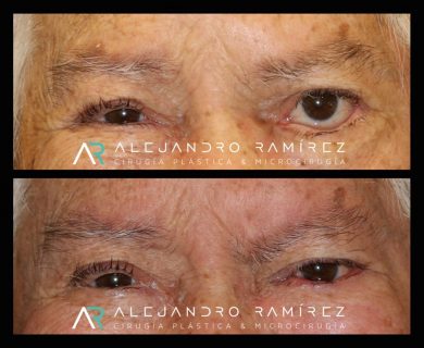 Reconstrucción facial: Microcirugía en parálisis facial