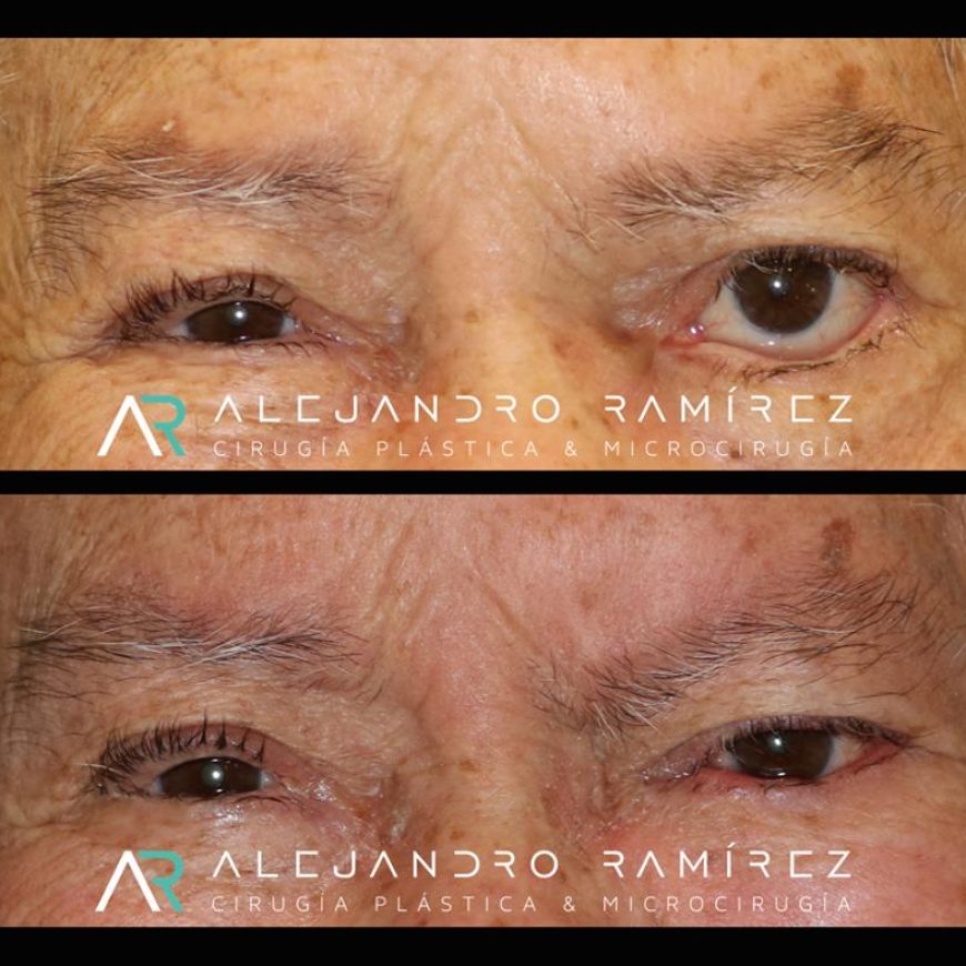 Reconstrucción facial: Microcirugía en parálisis facial