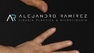 Mano y Linfedema                                                                       Hand and lymphedema