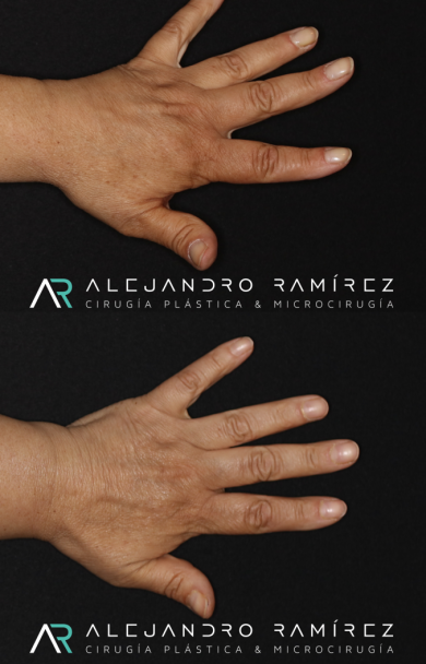 Mano y Linfedema                                                                       Hand and lymphedema