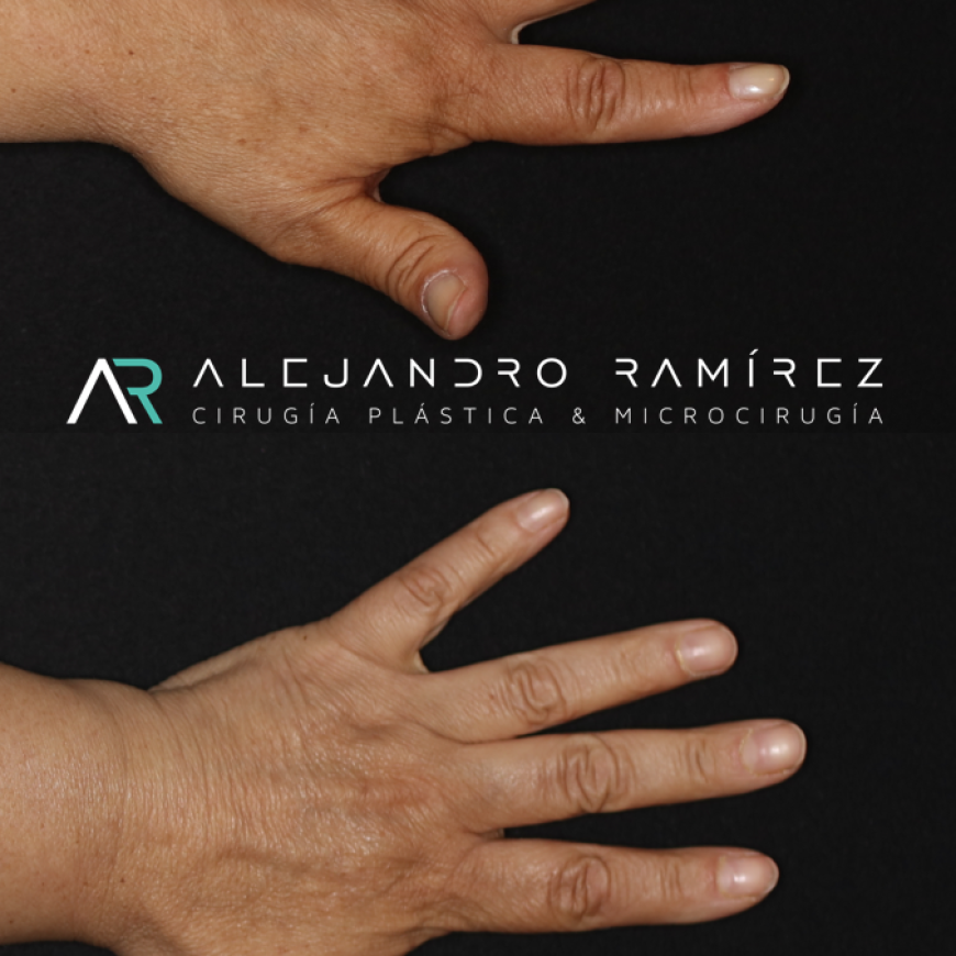 Mano y Linfedema                                                                       Hand and lymphedema