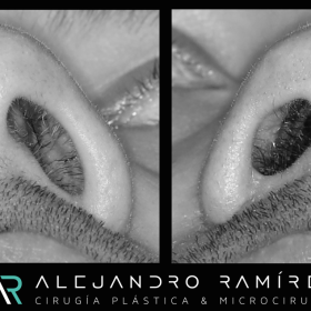 reconstruccion-estetica-de-nariz-dr-alejandro-ramirez.png