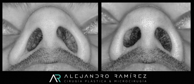 [:es]Reconstrucción estética de la narizCosmetic reconstruction of the nose[:]
