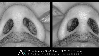 [:es]Reconstrucción estética de la narizCosmetic reconstruction of the nose[:]