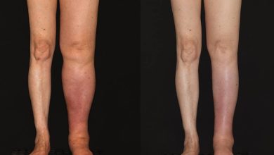 Trasplante de ganglios para linfedema por cancer cervicouterino                                                                        Lymph node transplant for cervical cancer