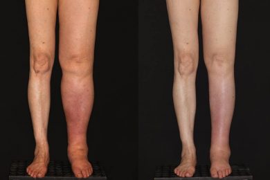 Trasplante de ganglios para linfedema por cancer cervicouterino                                                                        Lymph node transplant for cervical cancer