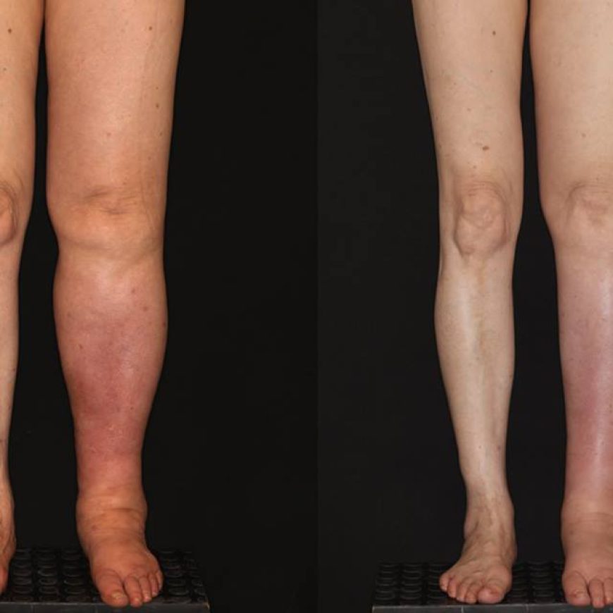 Trasplante de ganglios para linfedema por cancer cervicouterino                                                                        Lymph node transplant for cervical cancer