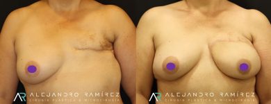 Reconstrucción mamaria con microcirugía, la mejor opción de reconstrucción                                  Microsurgical breast reconstruction, the best reconstructive option.