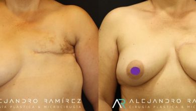 Reconstrucción mamaria con microcirugía, la mejor opción de reconstrucción                                  Microsurgical breast reconstruction, the best reconstructive option.