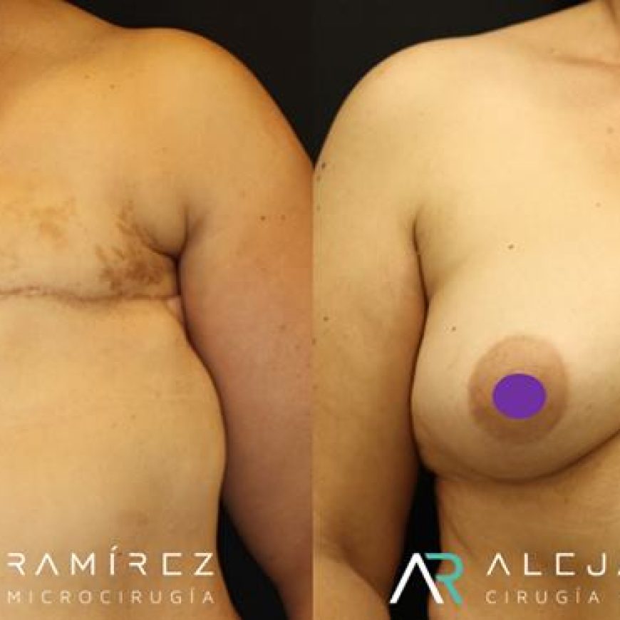 Reconstrucción mamaria con microcirugía, la mejor opción de reconstrucción                                  Microsurgical breast reconstruction, the best reconstructive option.