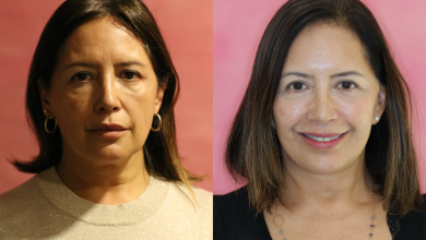 Resultados Lifting Facial Deep Plane