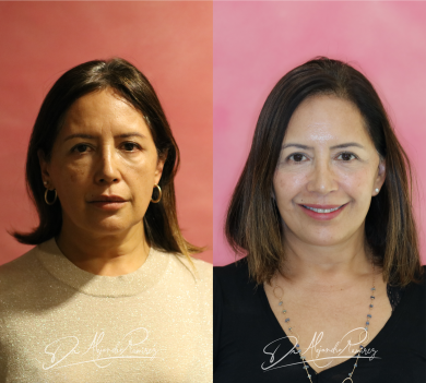 Resultados Lifting Facial Deep Plane