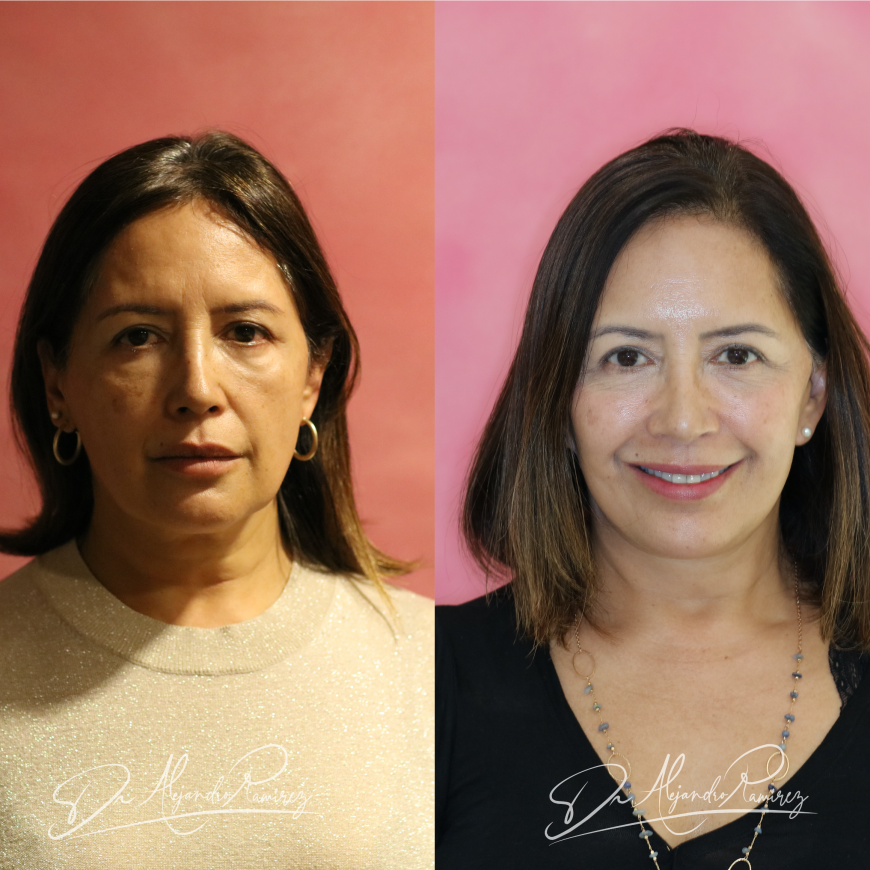 Resultados Lifting Facial Deep Plane
