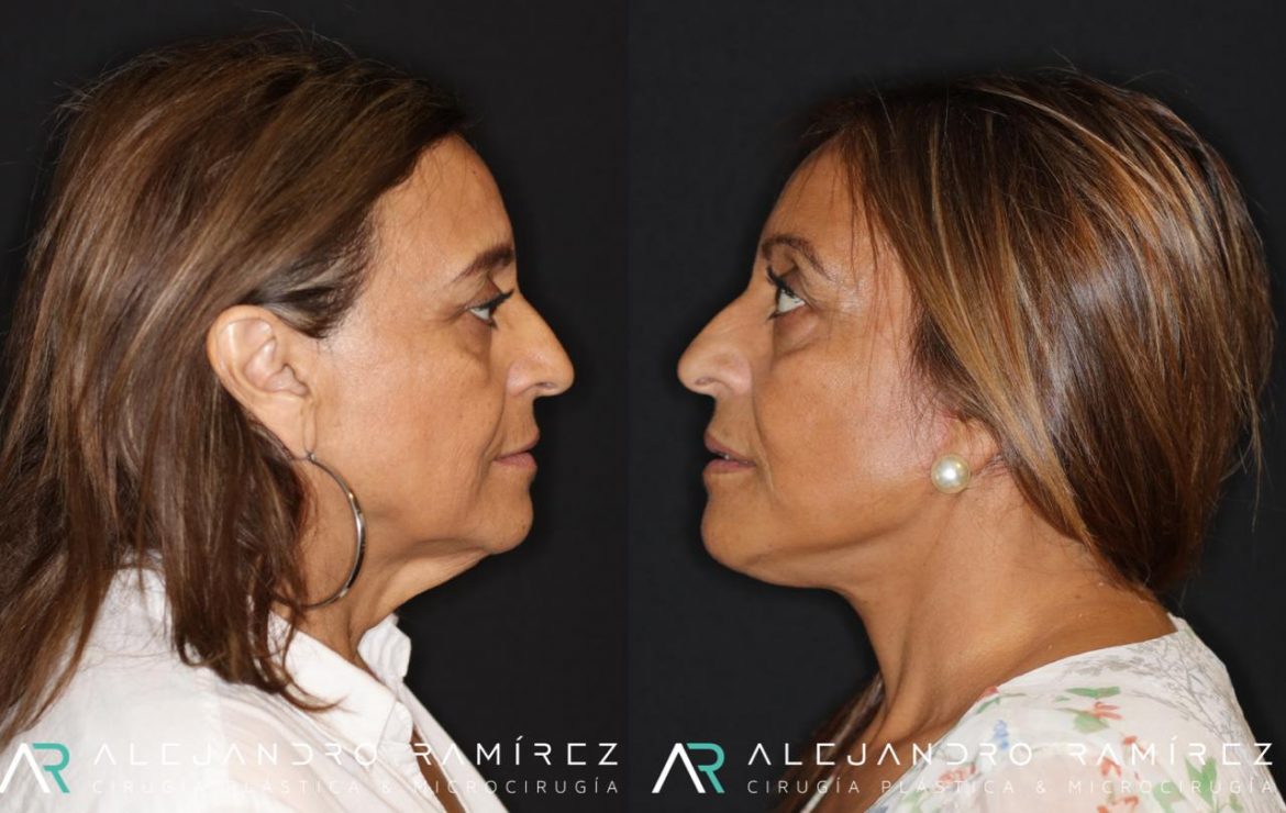Cirugia-de-Lifting-facial-Dr.-Alejandro-Ramirez-1.jpeg