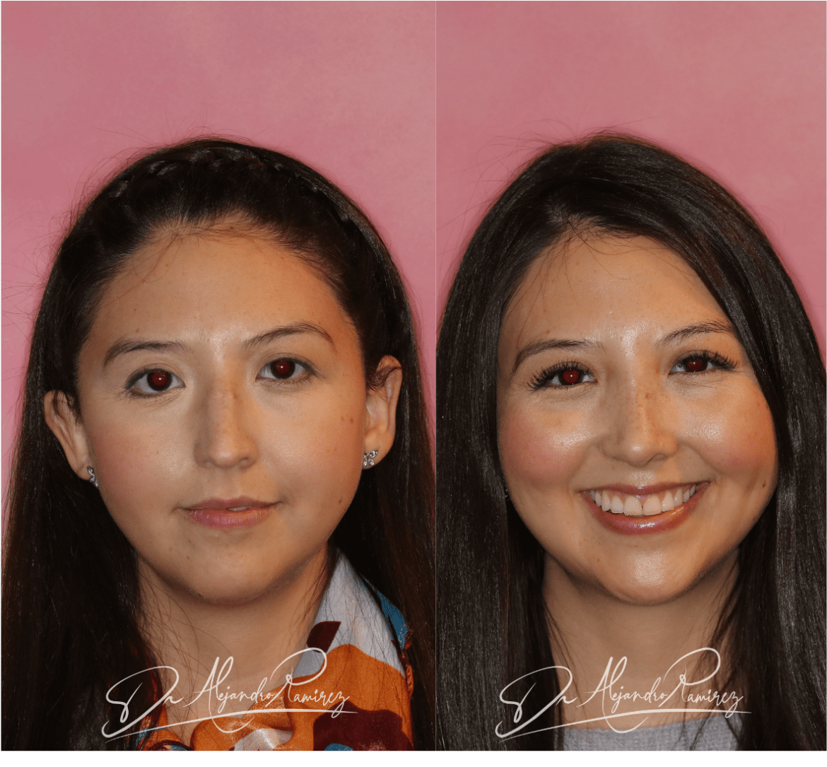 23-dr-alejandro-ramirez-mejor-cirugia-plastica-mejor-cirujano-plastico-rinoplastia.png