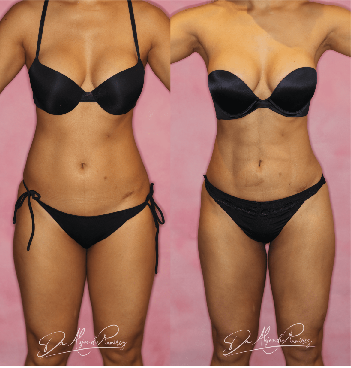 36-dr-alejandro-ramirez-mejor-cirugia-plastica-mejor-cirujano-plastico-lipoescultura-HD.png