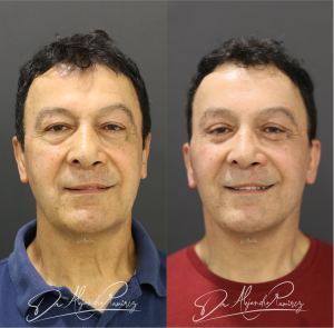 Resultado Lifting Dr. Alejandro Ramírez Cirujano Plástico