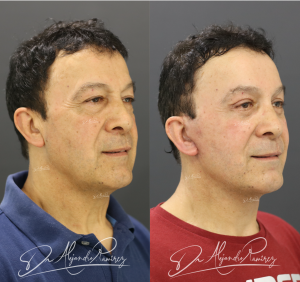 Dr. Alejandro Ramírez Cirujano Plástico