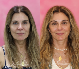 Lifting Facial Dr. Alejandro Ramírez