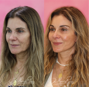 Lifting Facial Dr. Alejandro Ramírez