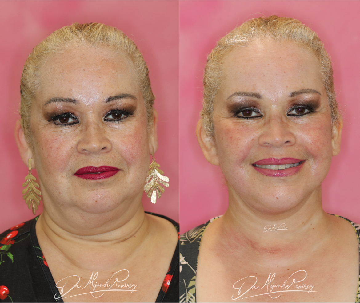 lifting-facial-dr.-alejandro-ramirez-.png