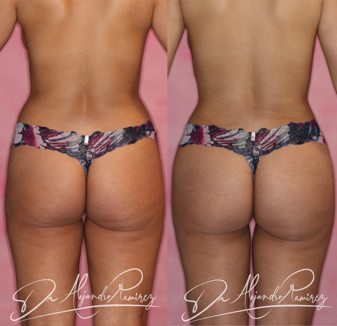 aumento-gluteo-dr-alejandro-ramirez-.jpg