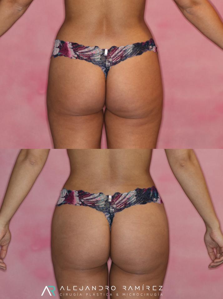 aumento-gluteo-dr-alejandro-ramirez-1.jpg