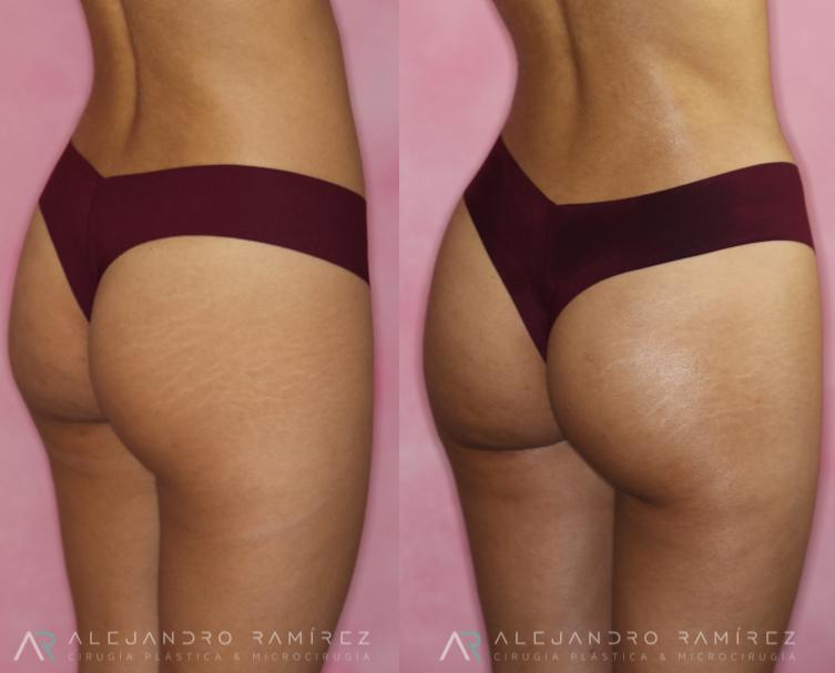 aumento-gluteo-dr-alejandro-ramirez.jpg