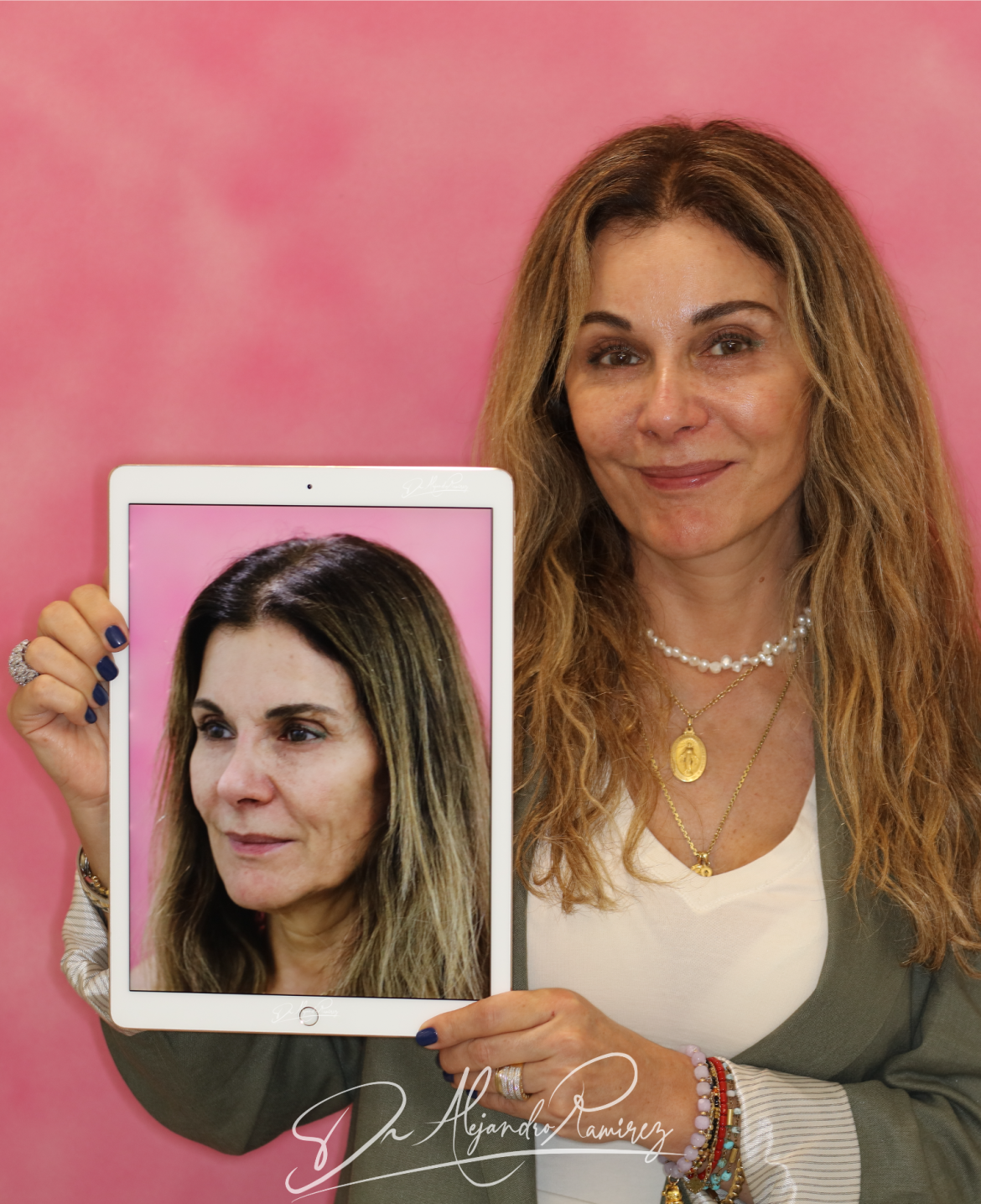 cirugia-lifting-facial-dr-alejandro-ramirez-mendoza.png