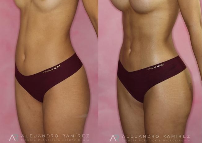 lipo-dr-alejandro-ramirez-.jpg
