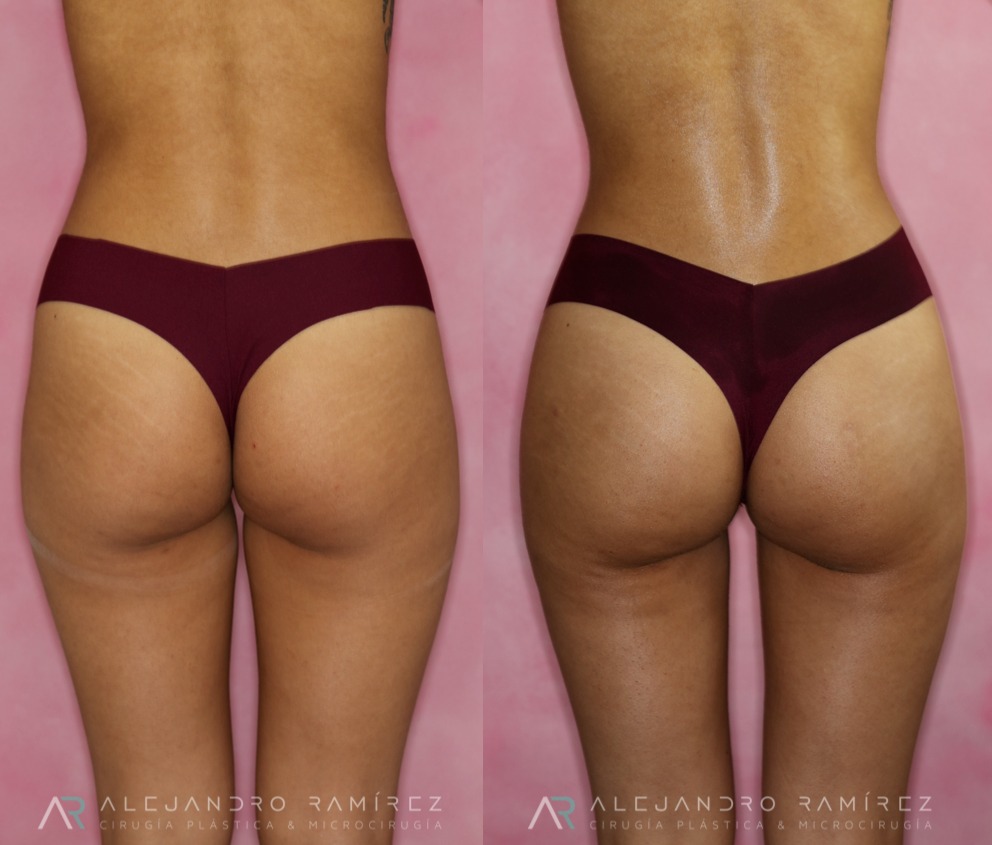lipo-hd-dr-alejandro-ramirez.jpg