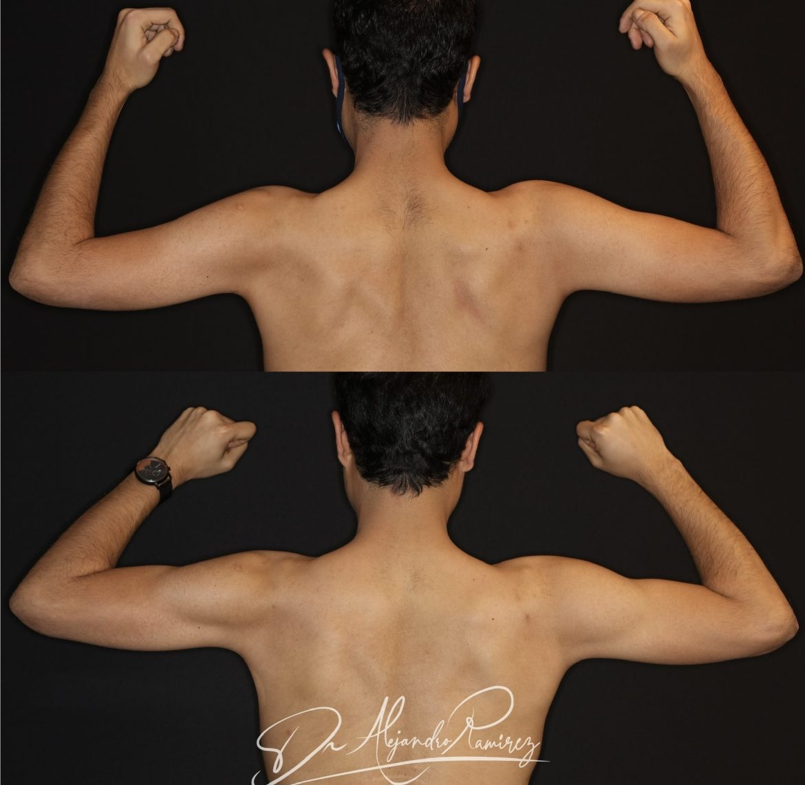 lipo-hd-hombre-dr-alejandro-ramirez.jpg