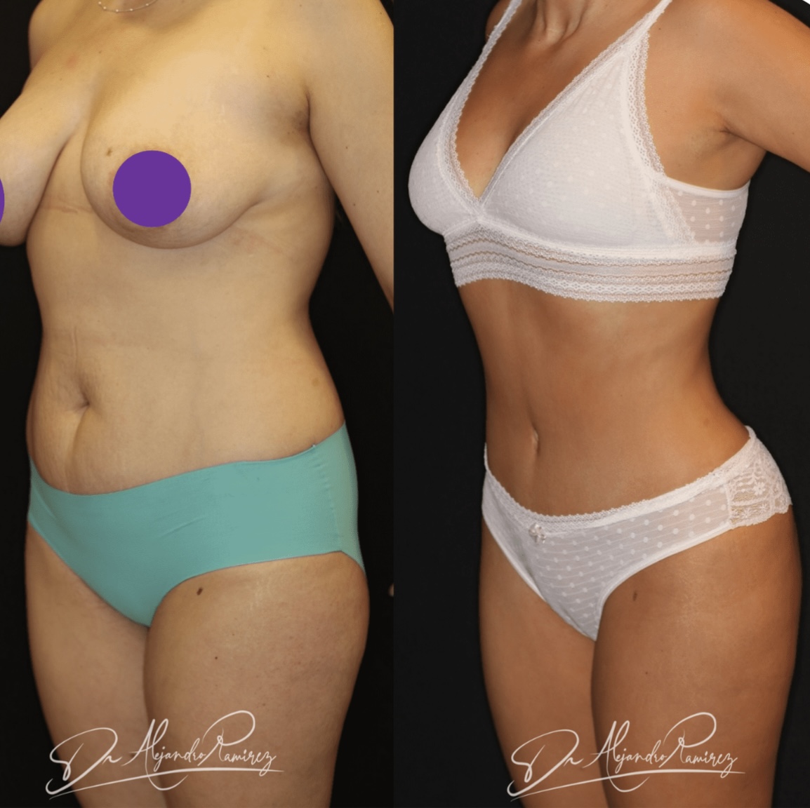 lipoabdominoplastia-dr-alejandro-ramirez.jpg