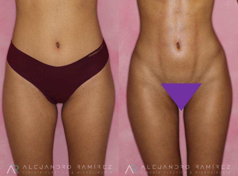 lipohd-dr-ramirez-alejandro.jpg
