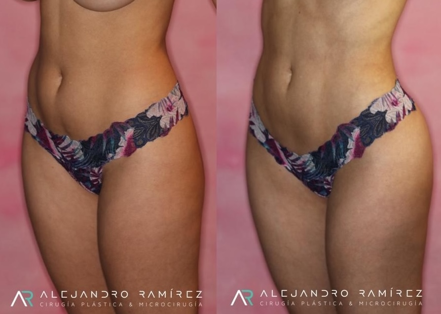 liposuccion-dr-alejandro-ramirez-.jpg