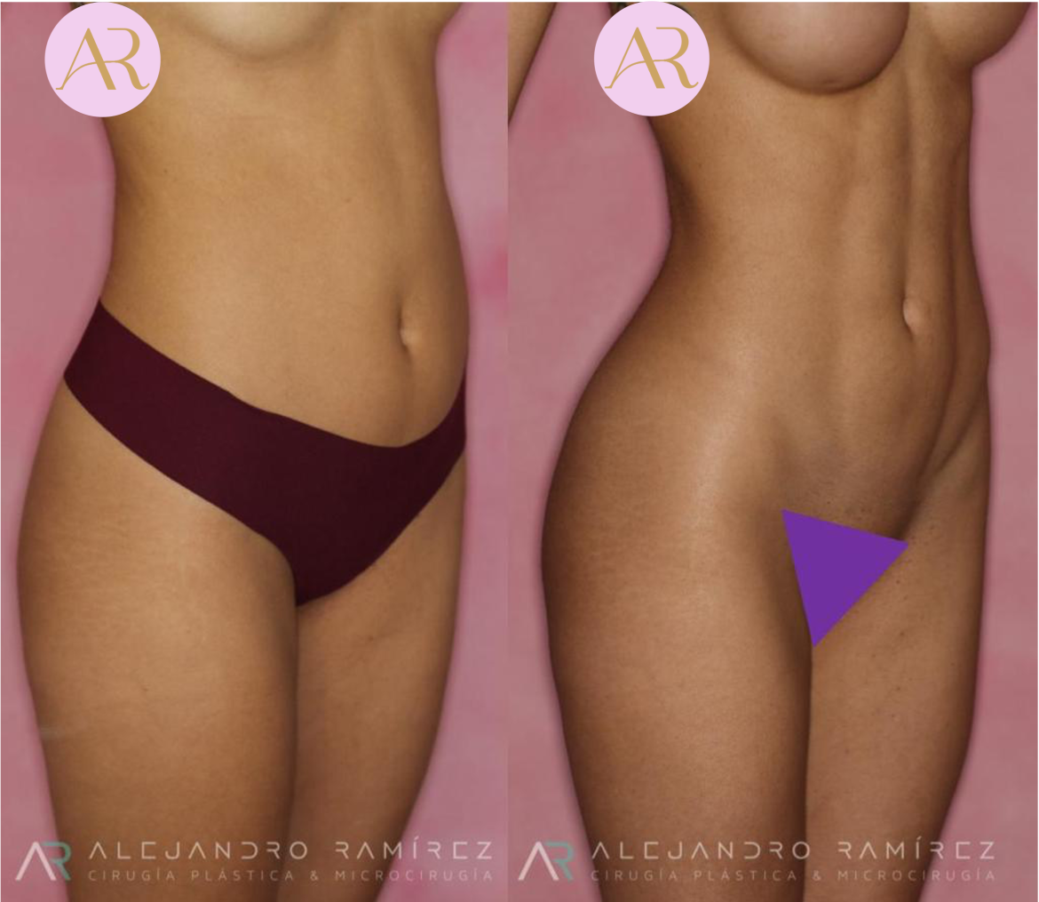 liposuccion-dr-alejandro-ramirez.png