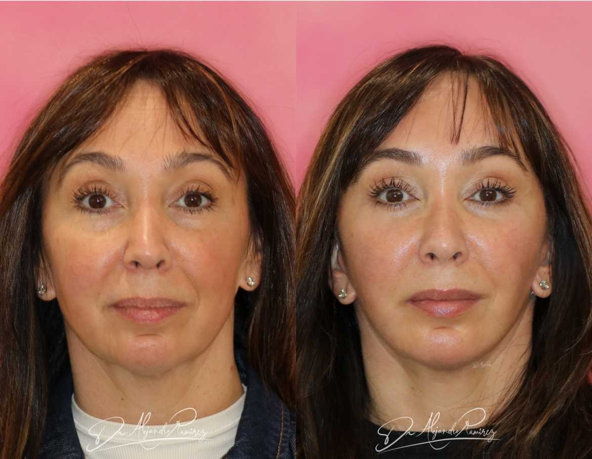 lifting-facial-Dr.-Alejandro-Ramirez-scaled.png
