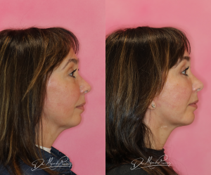 rejuvenecimiento facial dr alejandro ramirez