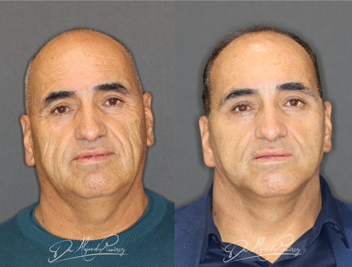 cirugia-de-lifting-facial-doctor-alejandro-ramirez-cirujano-plastico-scaled.png