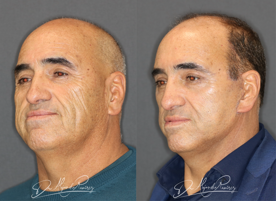 lifting-facial-dr-alejandro-ramirez-cirujano-plastico.png