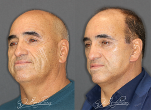 lifting facial dr alejandro ramirez cirujano plastico