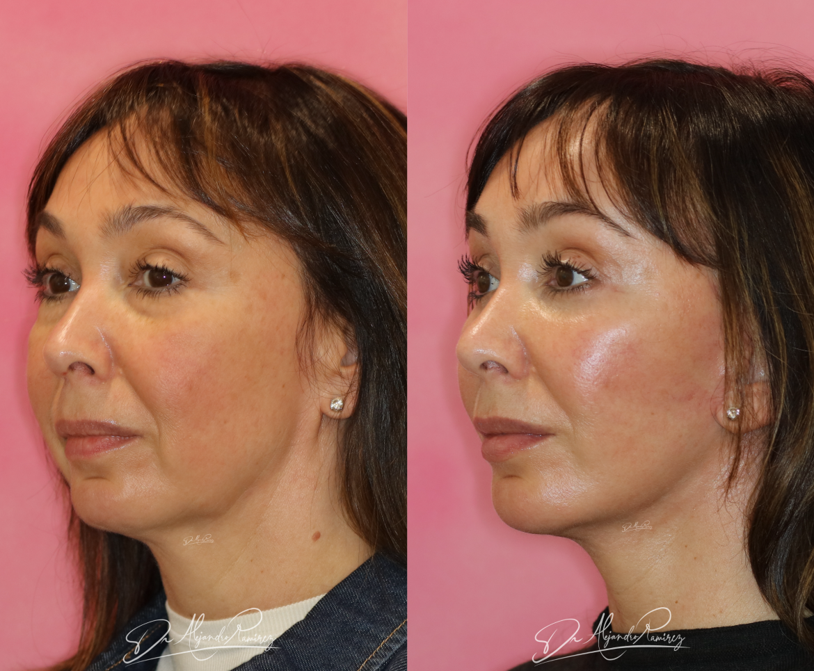 Lifting-Facial-Dr.-Alejandro-Ramirez-Cirujano-Plastico.png