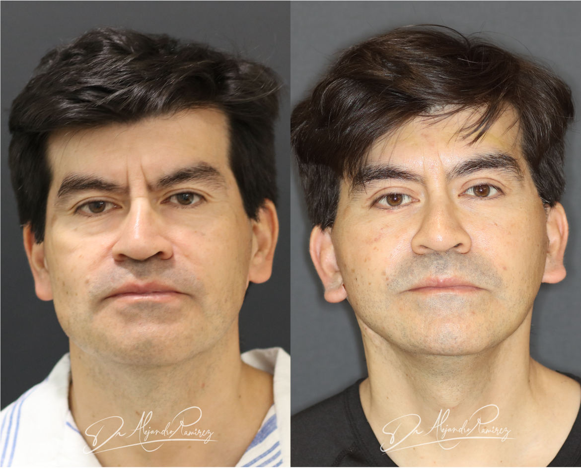 resultado-lifting-facial-dr-alejandro-ramirez-cirujano-plastico.png